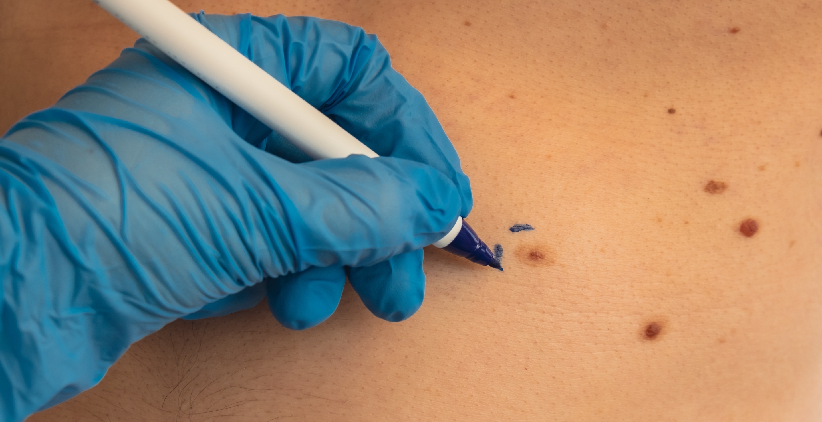 TV Host Surprised To Learn That He Has Skin Cancer While Live On The Air