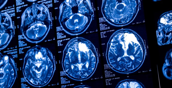 Terrifying Animation Shows What Happens To Your Brain As It Ages