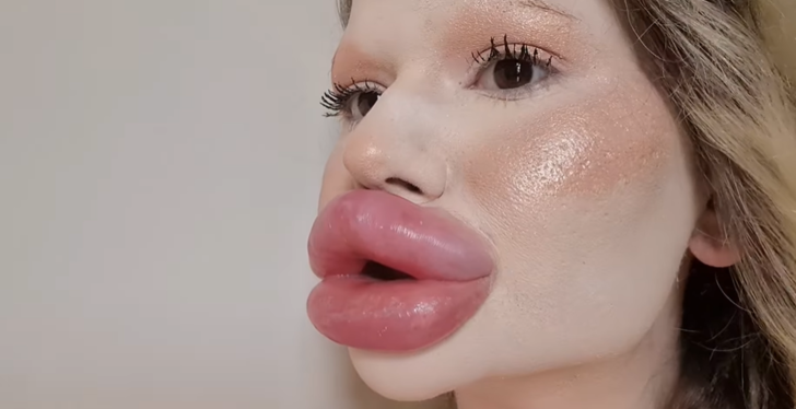 Woman With World's Largest Lips Looked Totally Different Before