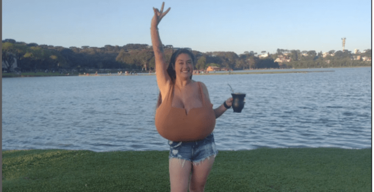 Woman's Breasts Began To Grow At Uncontrollable Size That She Eventually Needed A Wheelchair