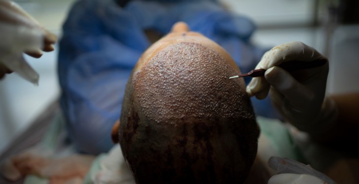 Man Dies After Getting A Botched Hair Transplant